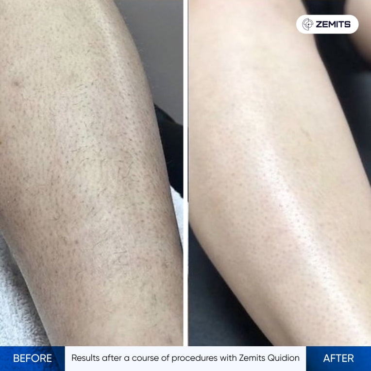 Zemits Quidion Laser de Diodo para Remoção de Pelos