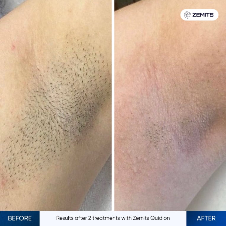 Zemits Quidion Laser de Diodo para Remoção de Pelos